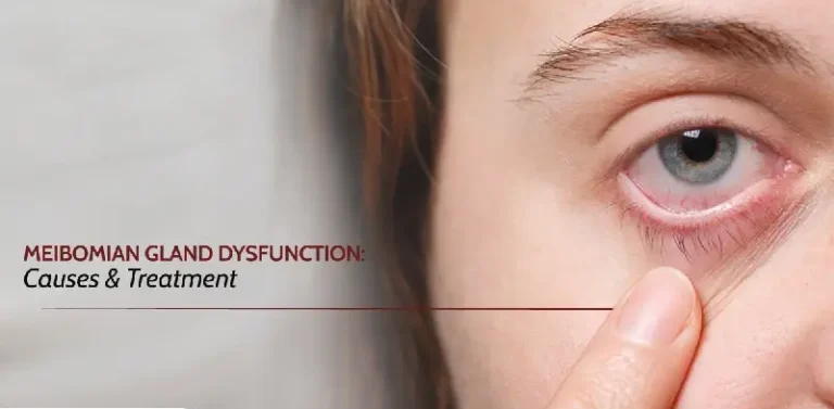 Meibomian Gland Dysfunction