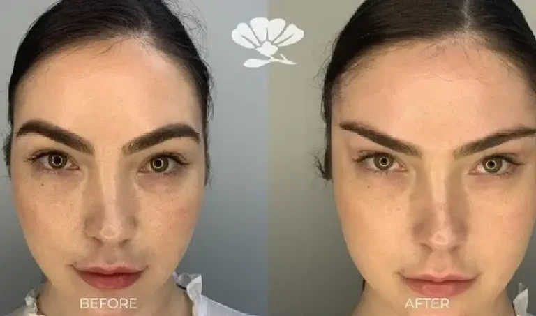 Fox Eye Lift